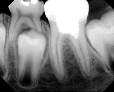 Послеоперативная рентгенограмма вылеченного зуба