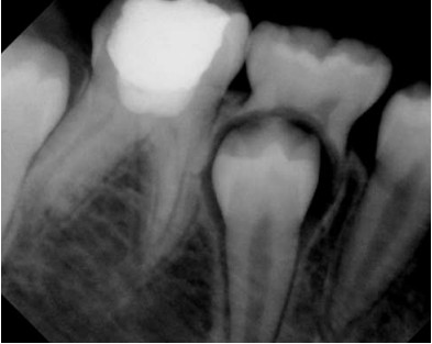 Послеоперативная рентгенограмма зуба, находящегося в процессе лечения